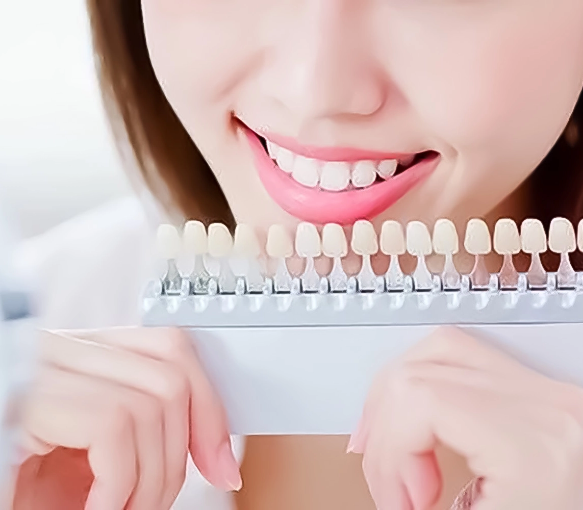 ホワイトニング